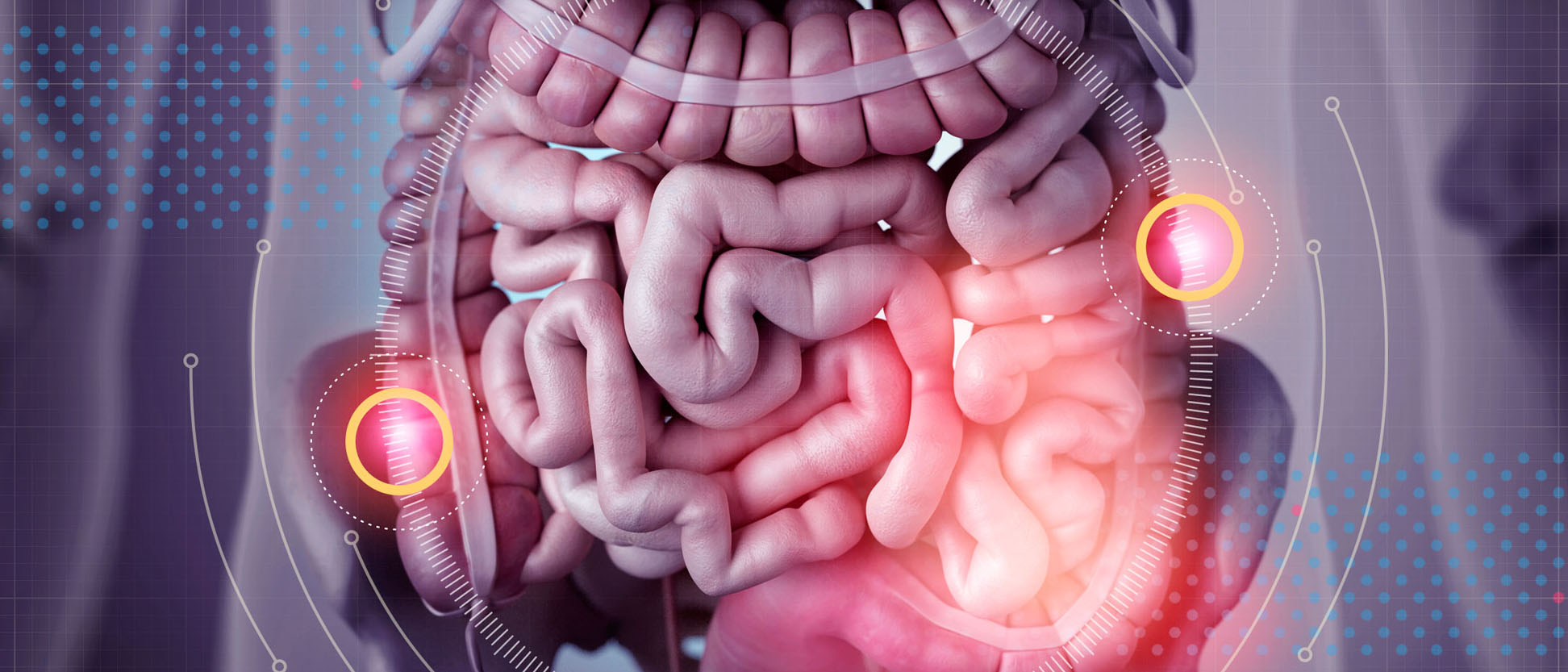 Bowel Cancer Treatment in Bella Vista